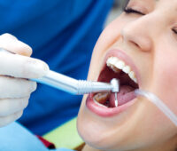 Root Canal Treatment