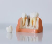 Dental Implants