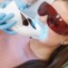 Teeth whitening