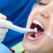 Root Canal Treatment